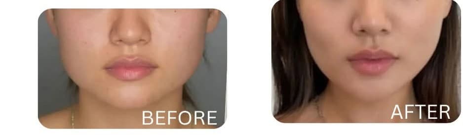 Buccal Fat Removal before and after