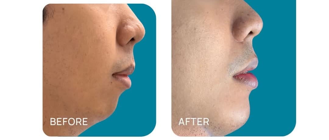 Chin Augmentation before and after
